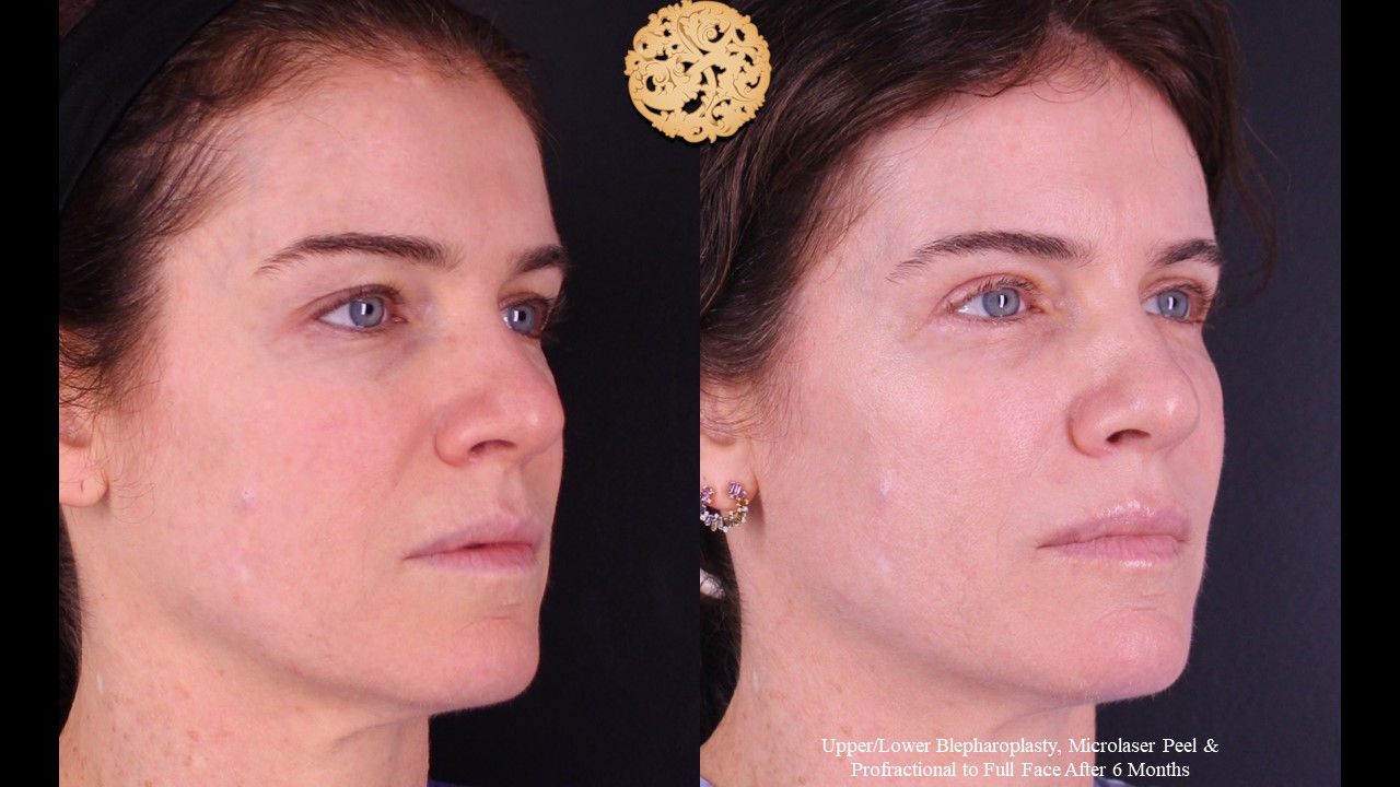 Profractional Before & After