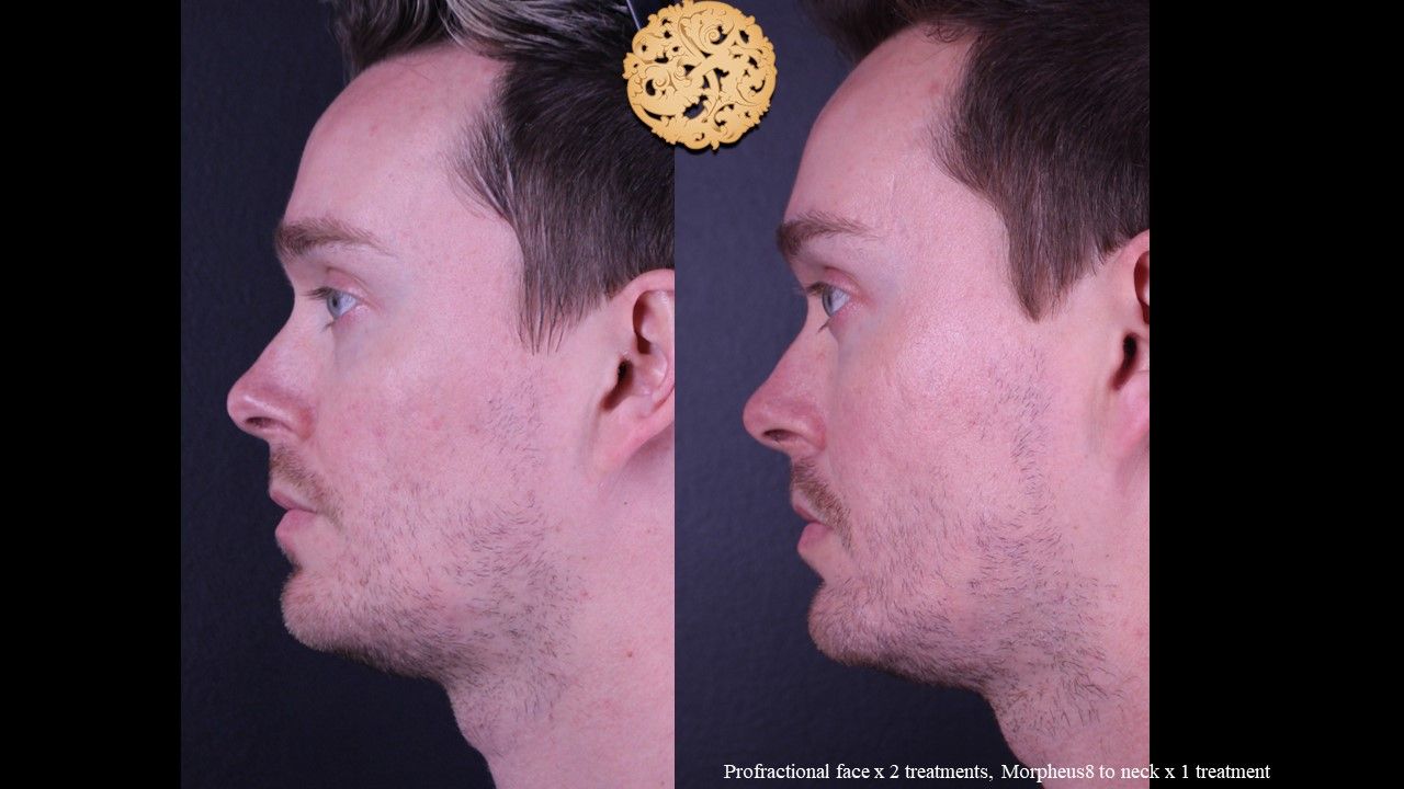 Profractional Before & After