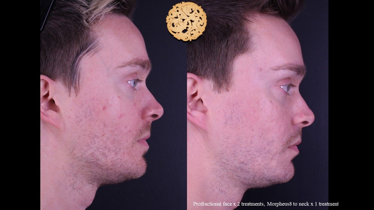 Profractional Before & After