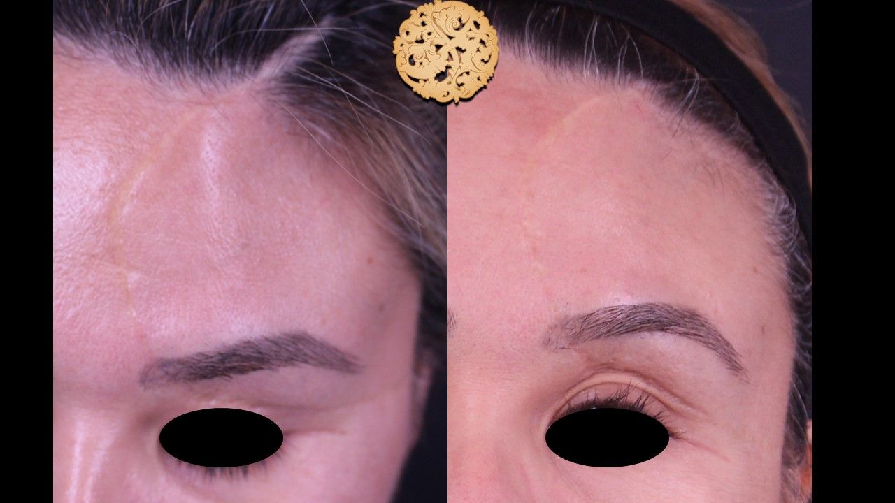Profractional Before & After