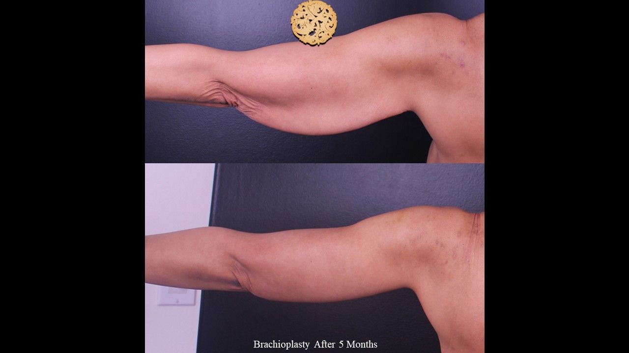 Brachioplasty Before & After