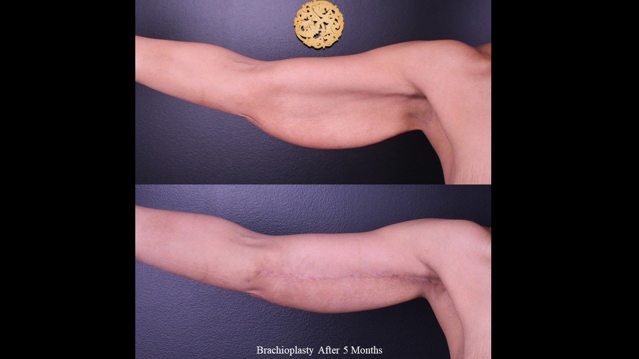 Brachioplasty Before & After