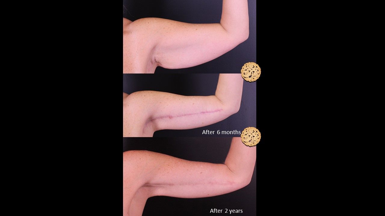 Brachioplasty Before & After