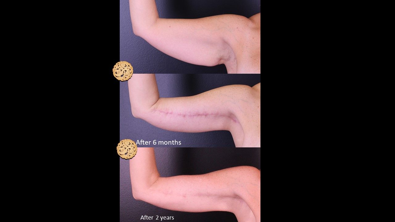 Brachioplasty Before & After