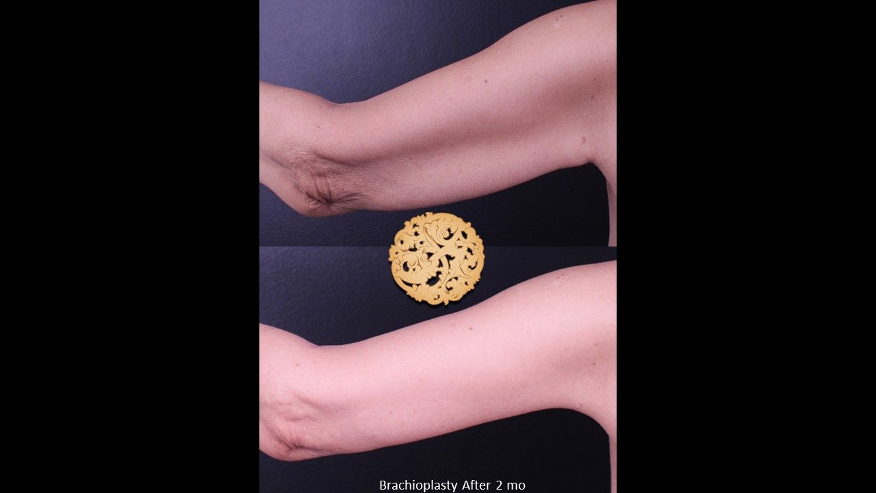 Brachioplasty Before & After