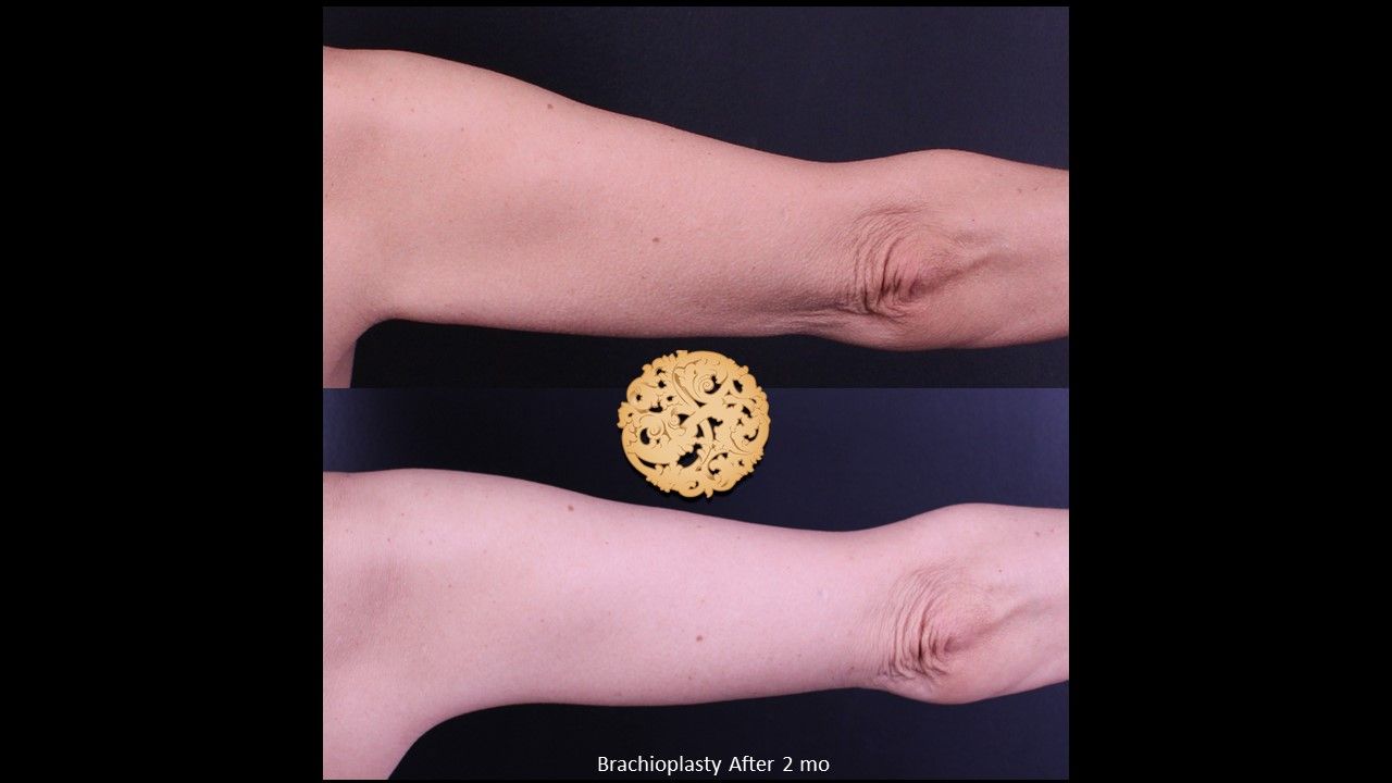 Brachioplasty Before & After