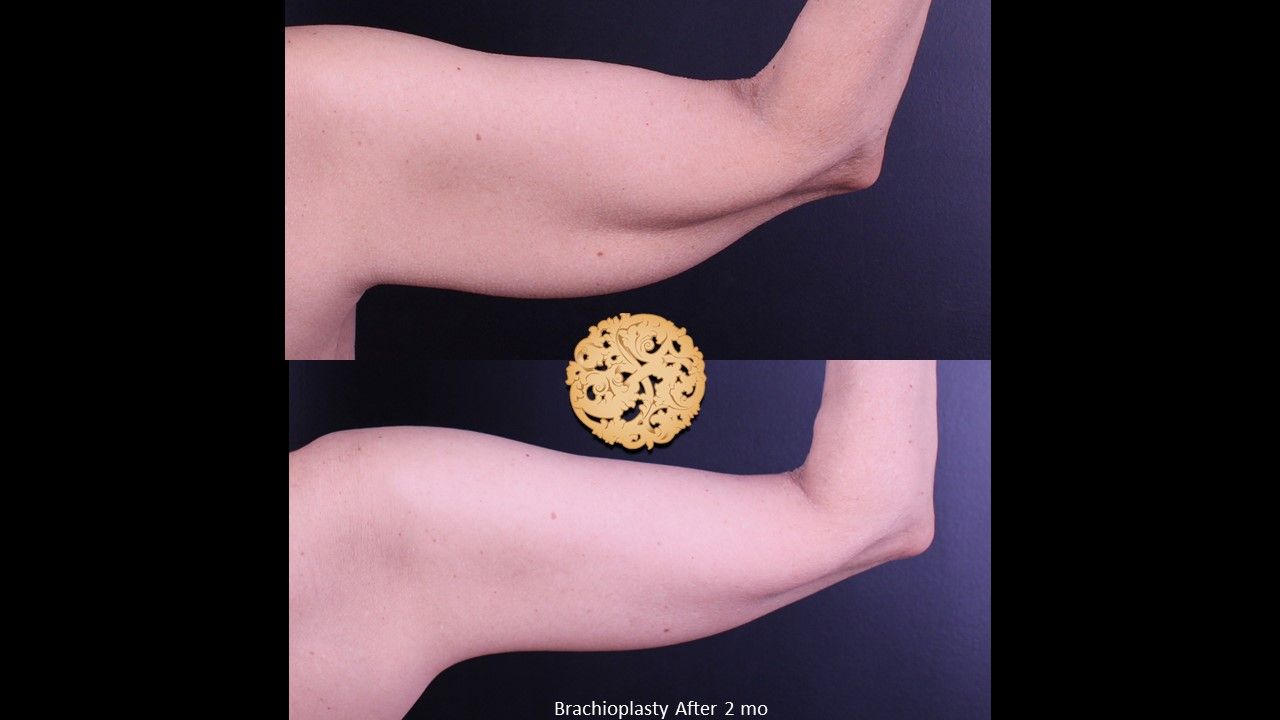 Brachioplasty Before & After