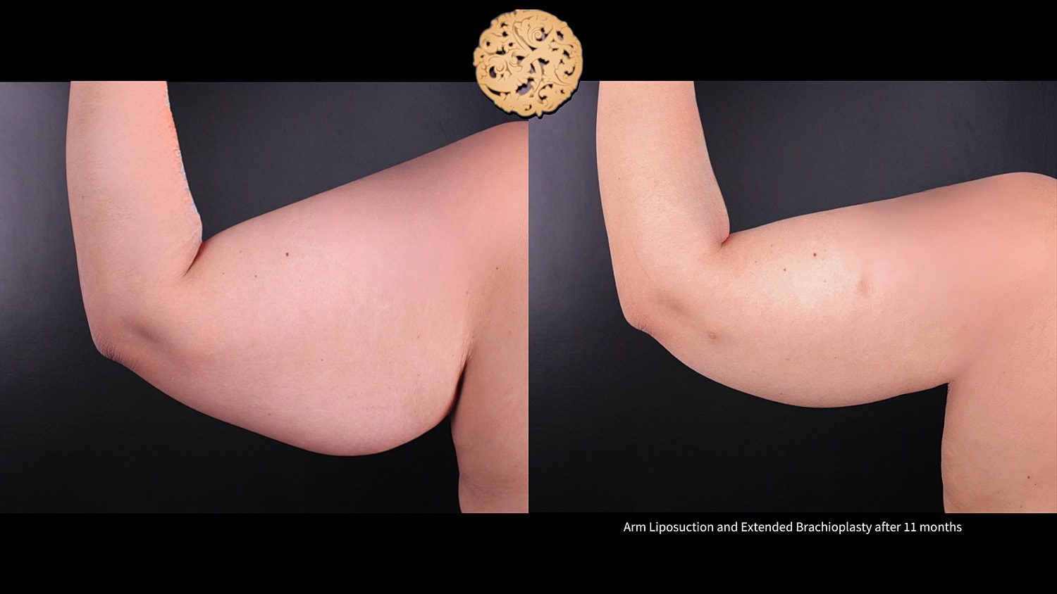 Brachioplasty Before & After