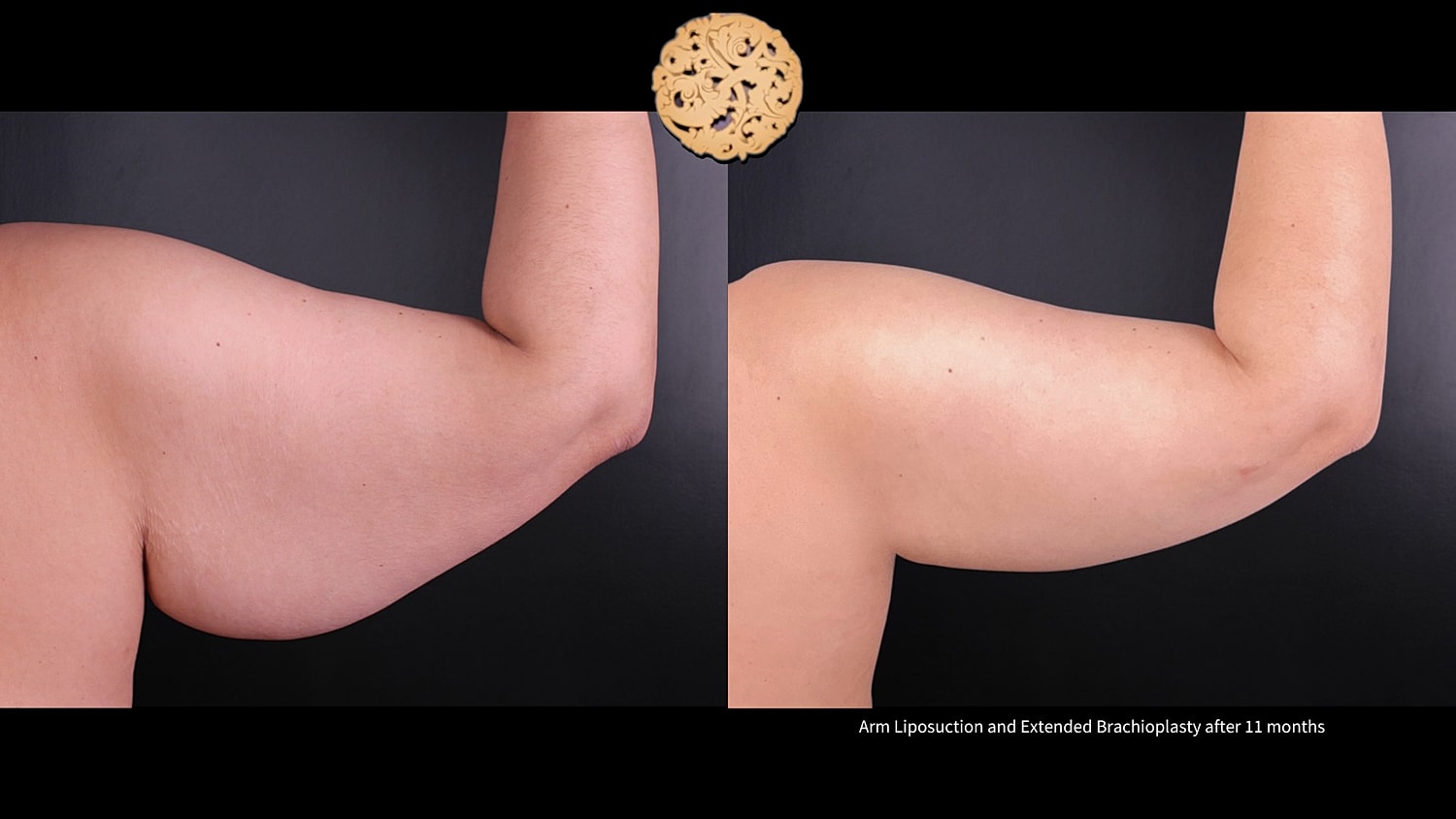 Brachioplasty Before & After