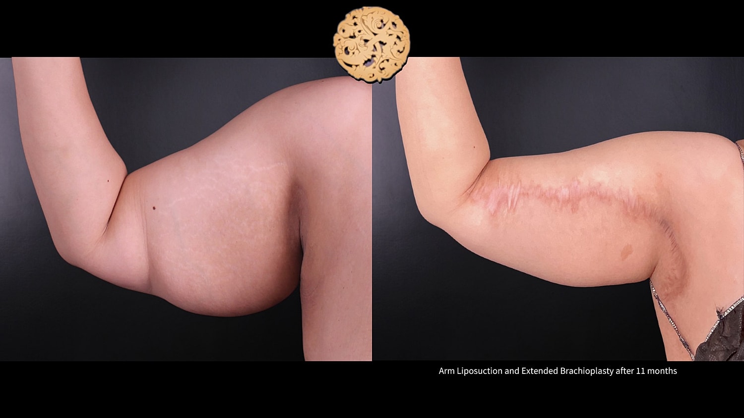 Brachioplasty Before & After