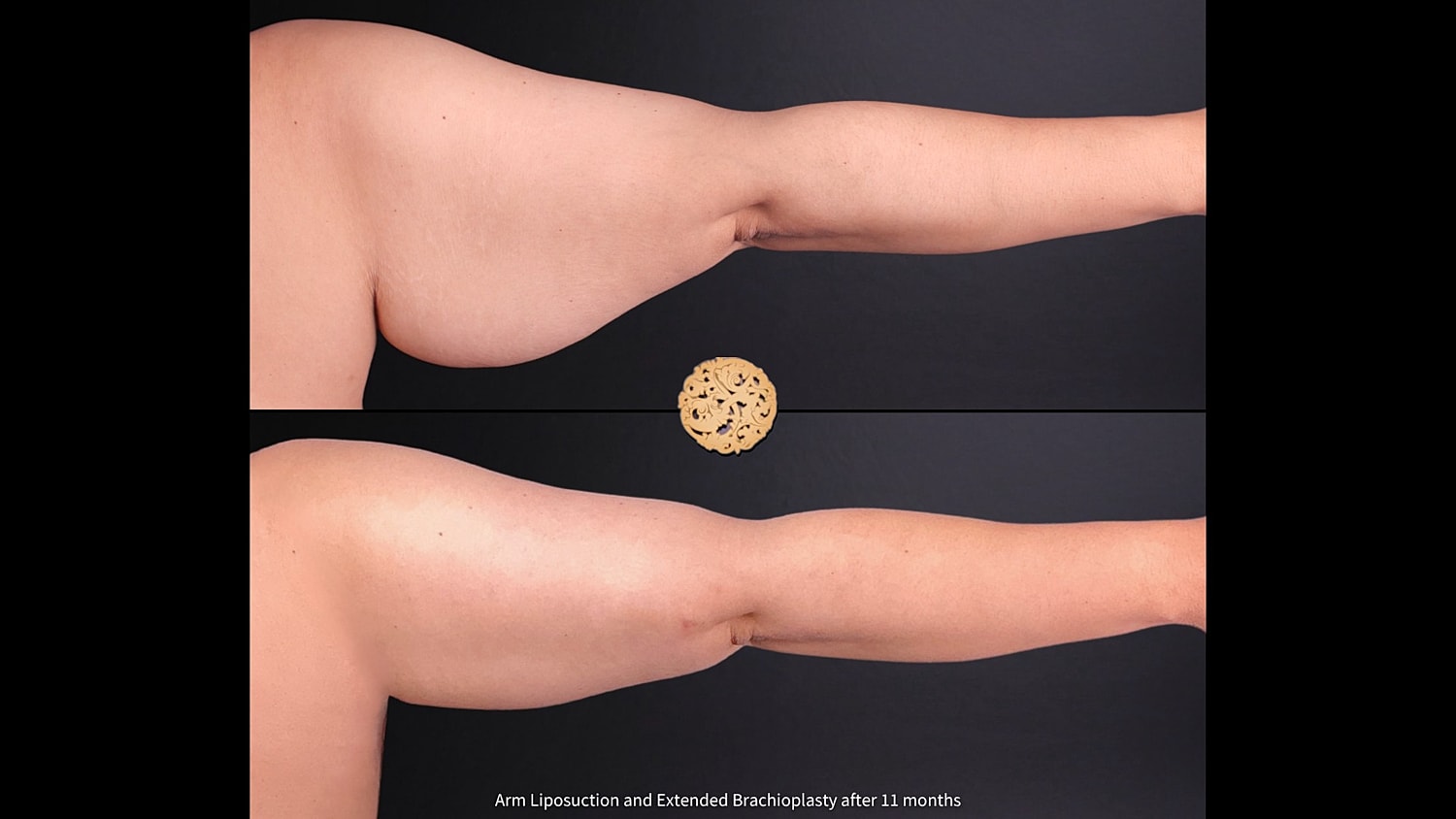 Brachioplasty Before & After