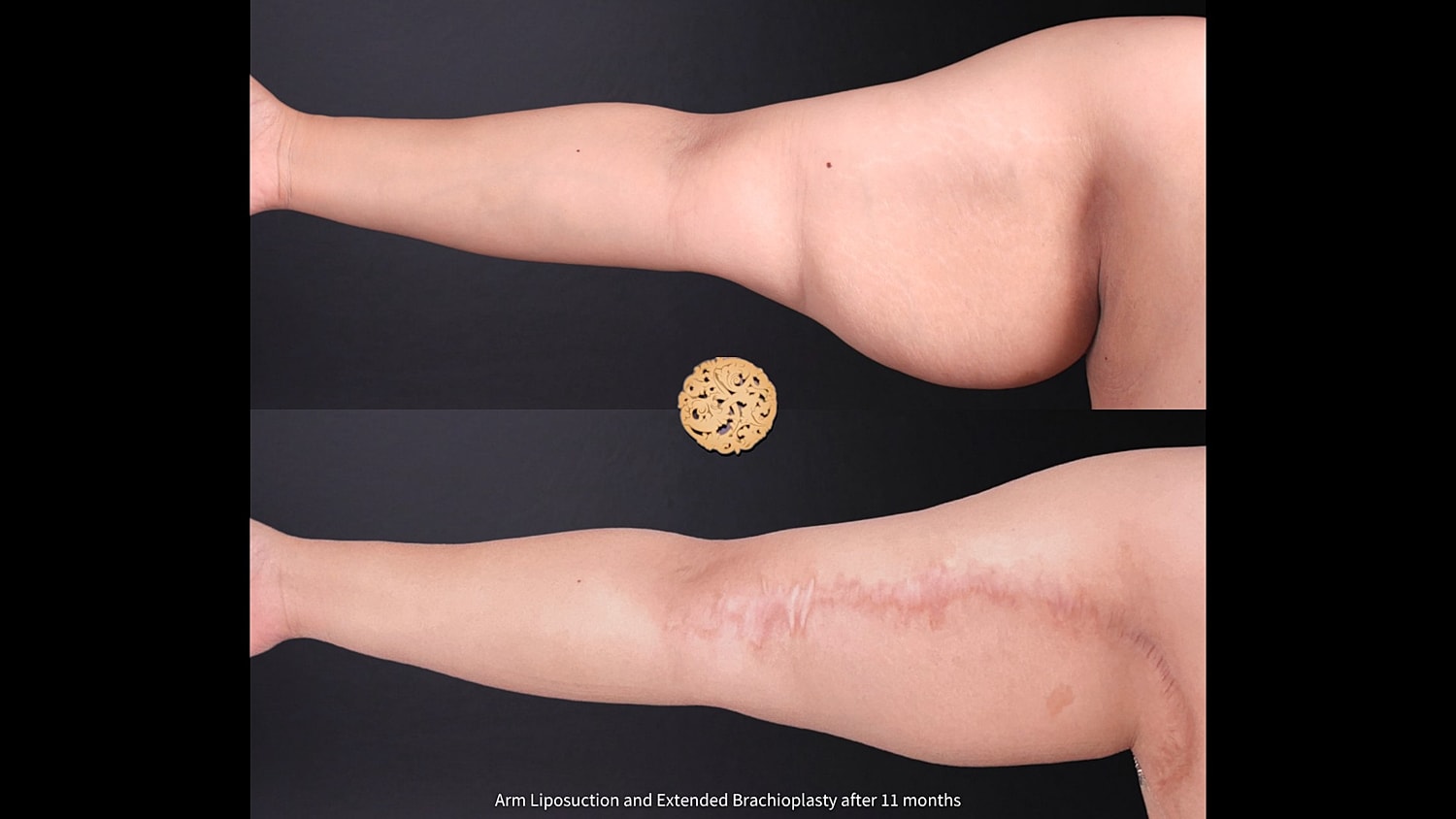 Brachioplasty Before & After