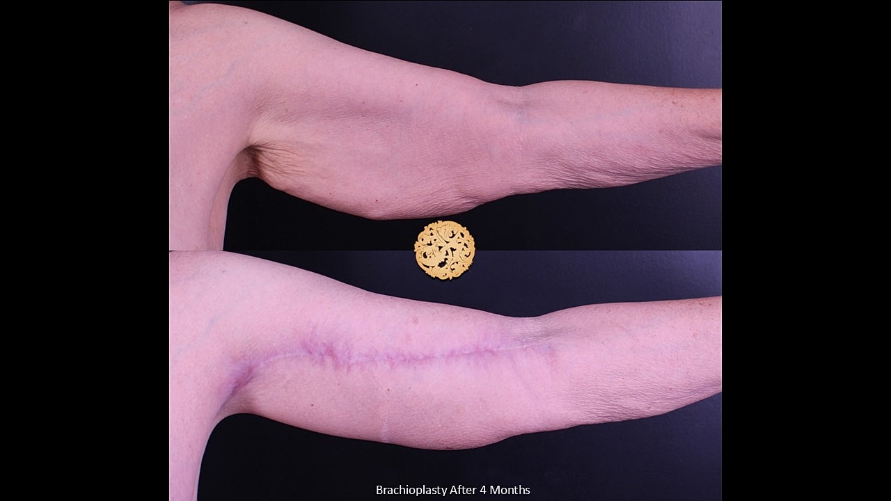 Brachioplasty Before & After