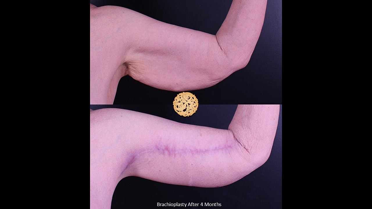 Brachioplasty Before & After