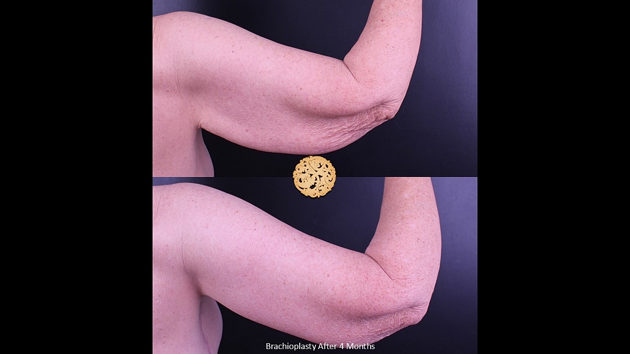 Brachioplasty Before & After