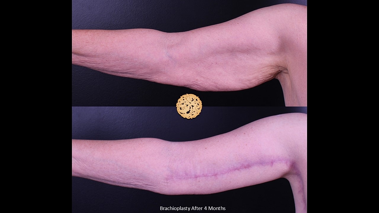 Brachioplasty Before & After