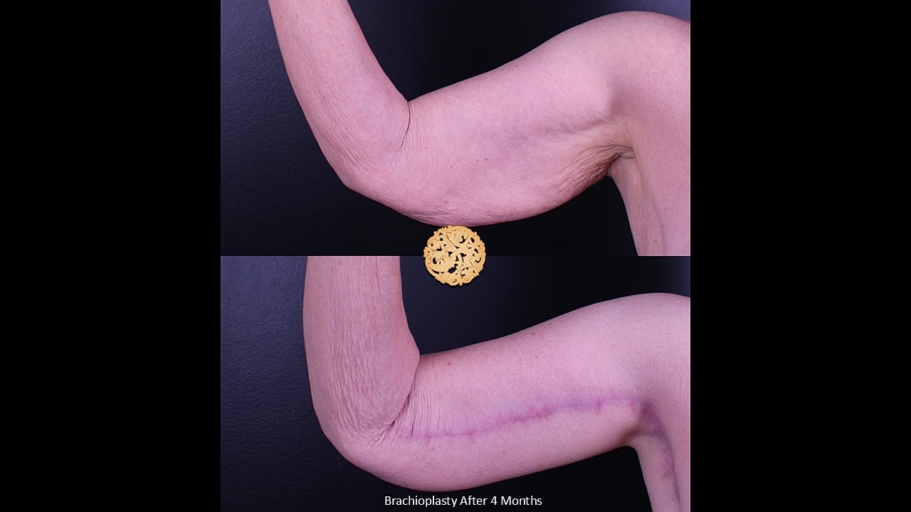 Brachioplasty Before & After