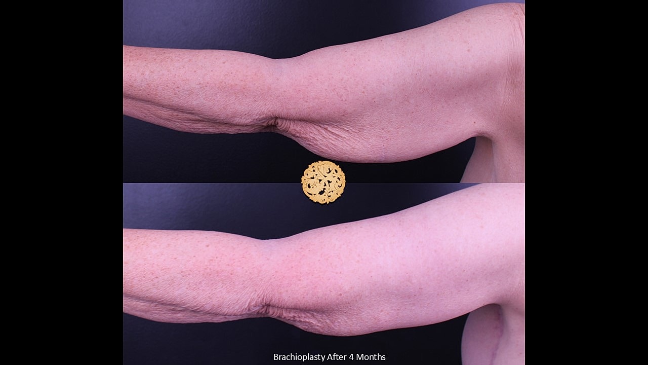 Brachioplasty Before & After
