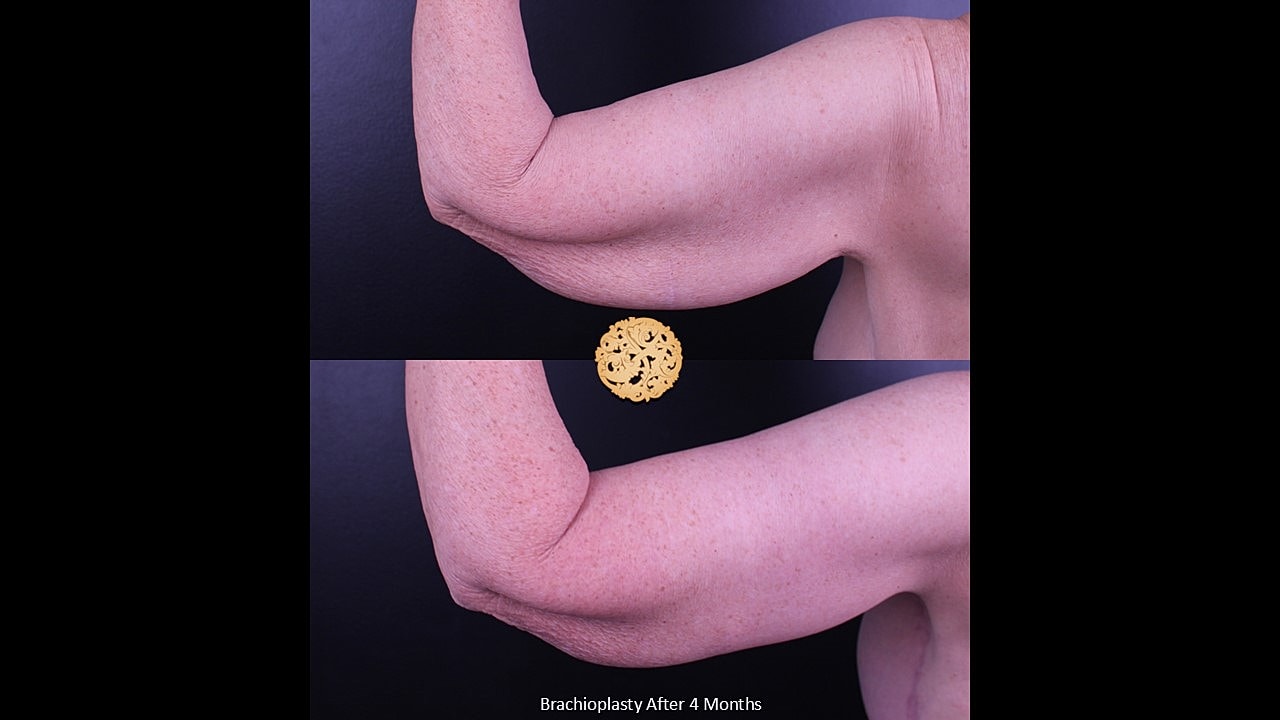 Brachioplasty Before & After