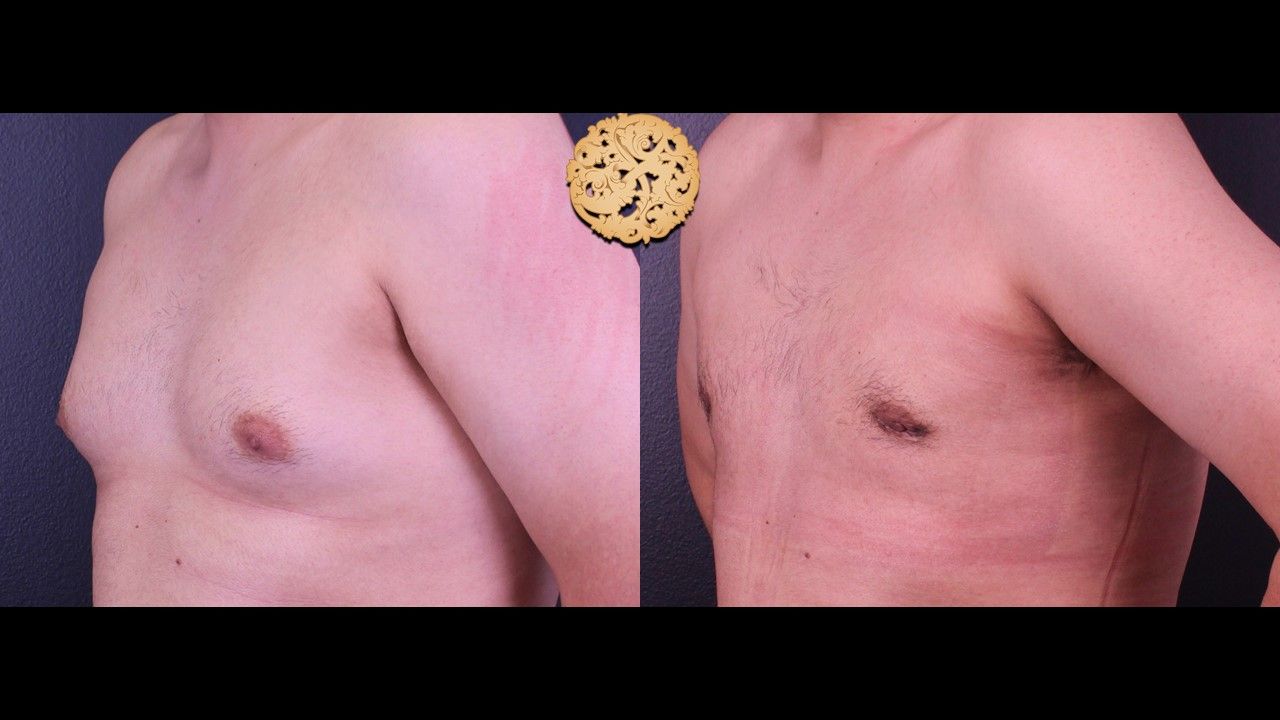 Gynecomastia Before & After