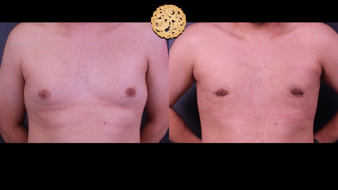 Gynecomastia Before & After