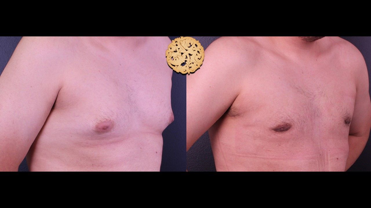 Gynecomastia Before & After