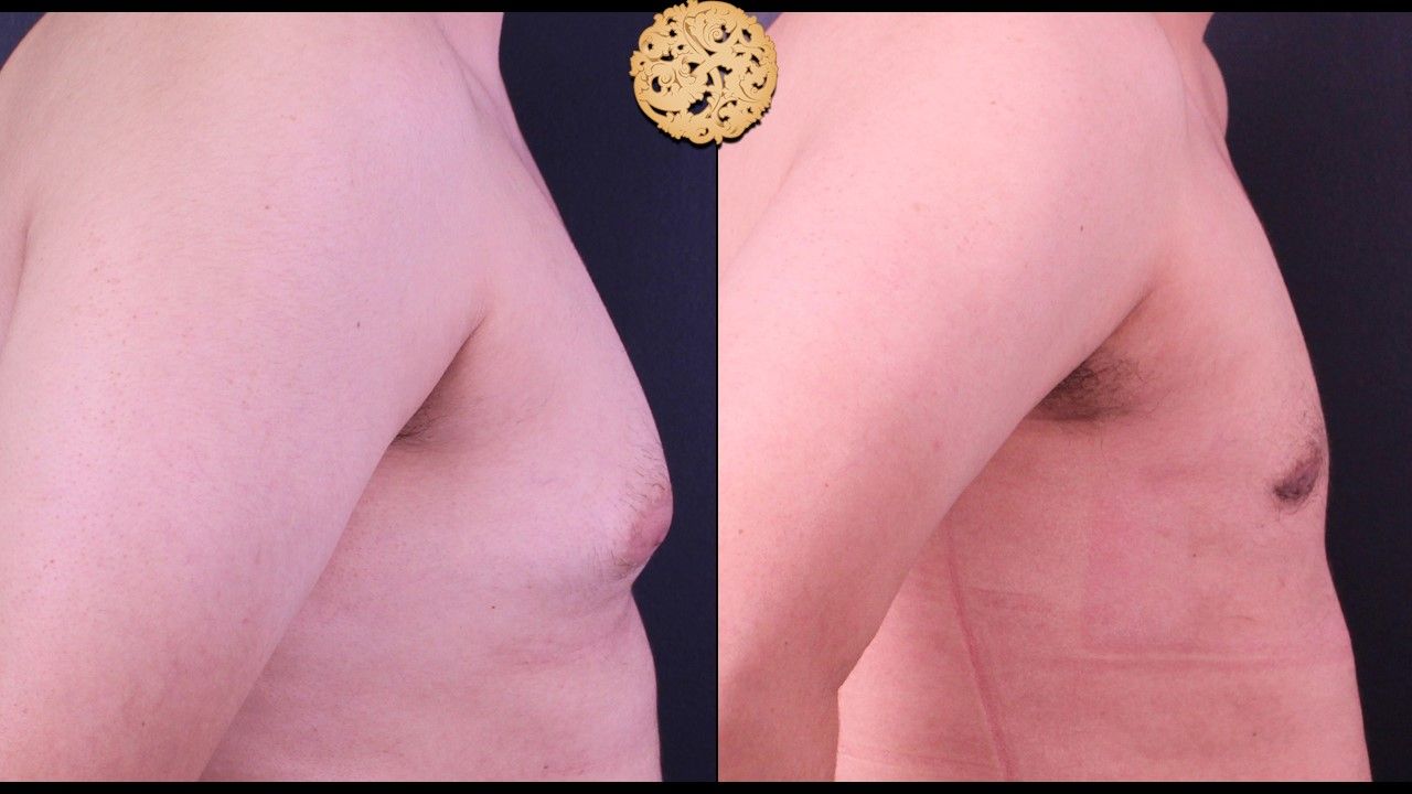 Gynecomastia Before & After