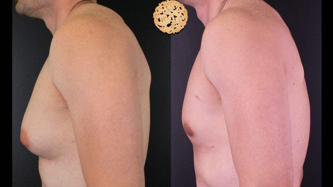 Gynecomastia Before & After