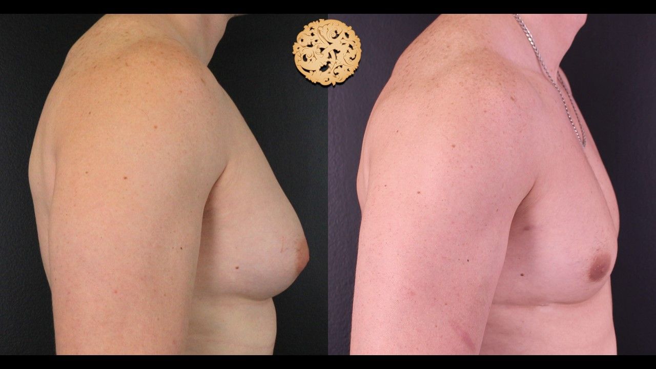 Gynecomastia Before & After