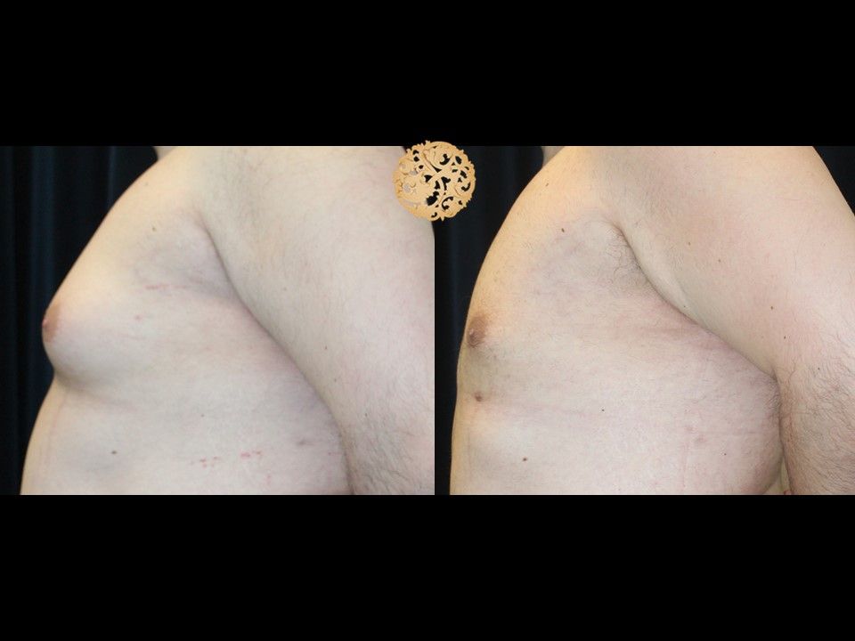 Gynecomastia Before & After