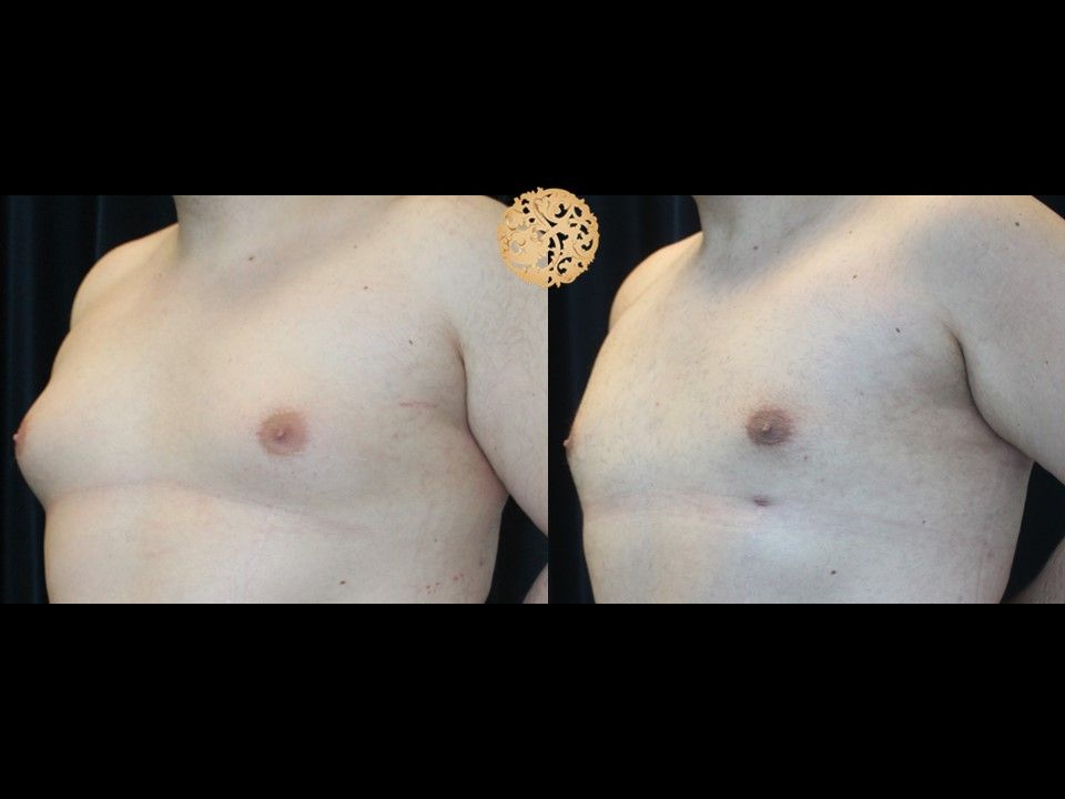 Gynecomastia Before & After