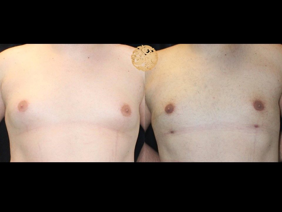Gynecomastia Before & After