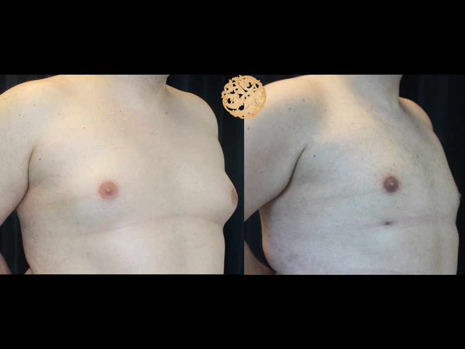 Gynecomastia Before & After