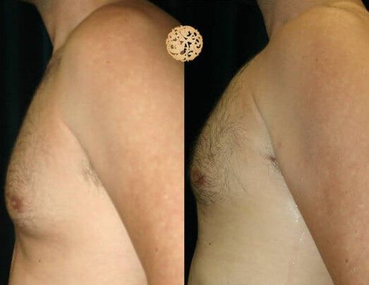 Gynecomastia Before & After