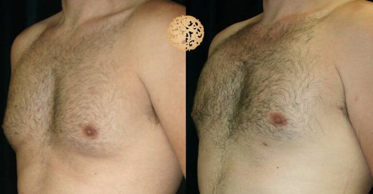 Gynecomastia Before & After