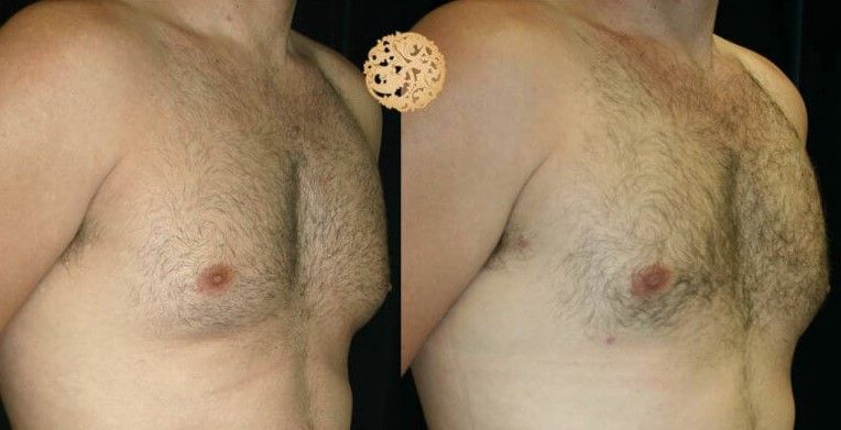 Gynecomastia Before & After