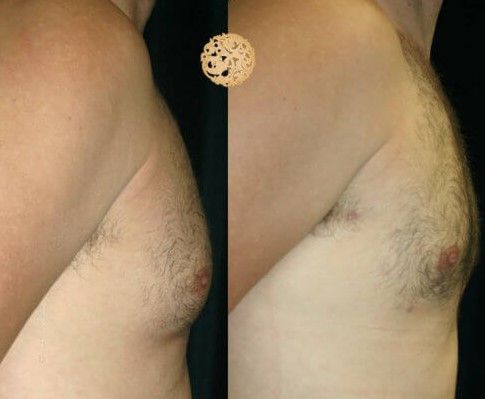 Gynecomastia Before & After