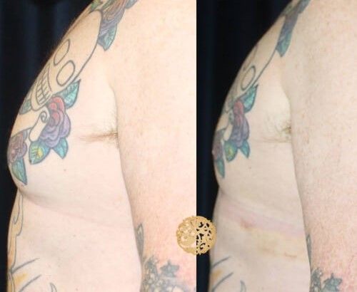Gynecomastia Before & After