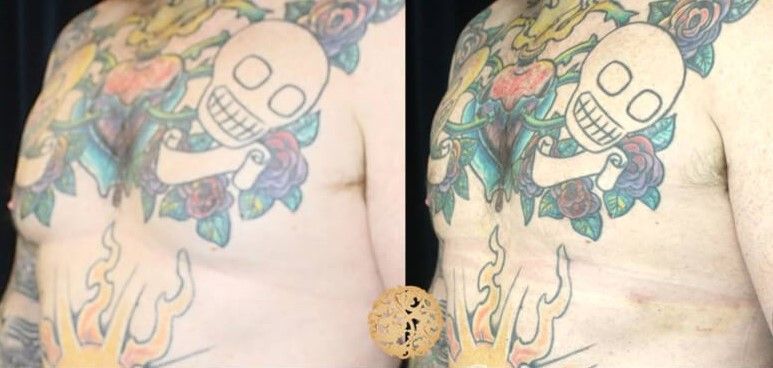 Gynecomastia Before & After