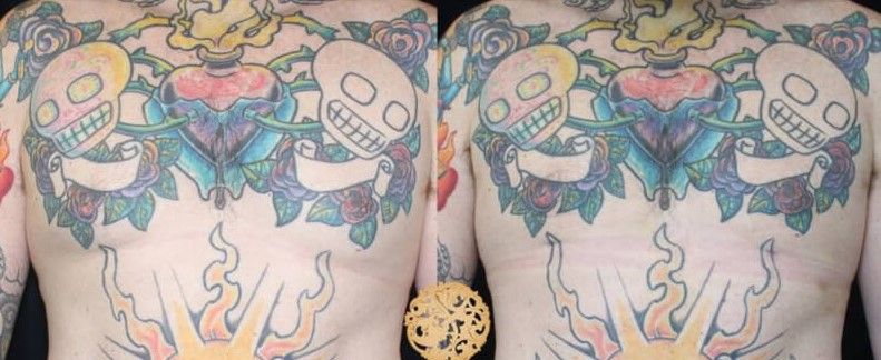 Gynecomastia Before & After