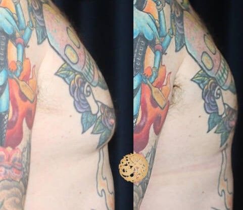 Gynecomastia Before & After