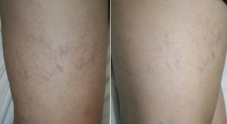 Vein Removal Before & After