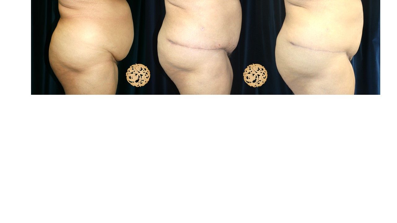 Panniculectomy Before & After
