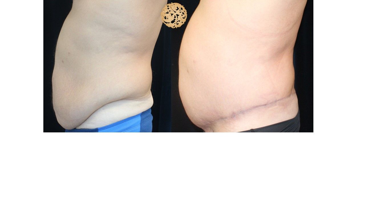 Panniculectomy Before & After