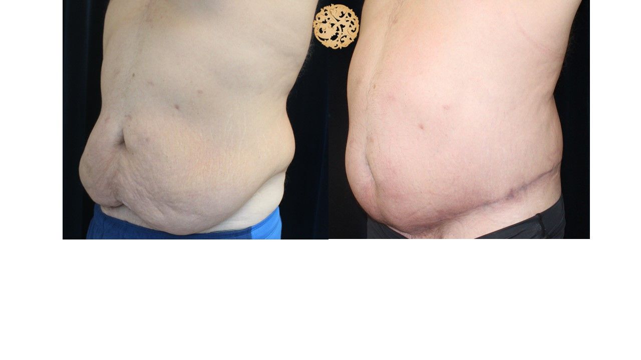 Panniculectomy Before & After