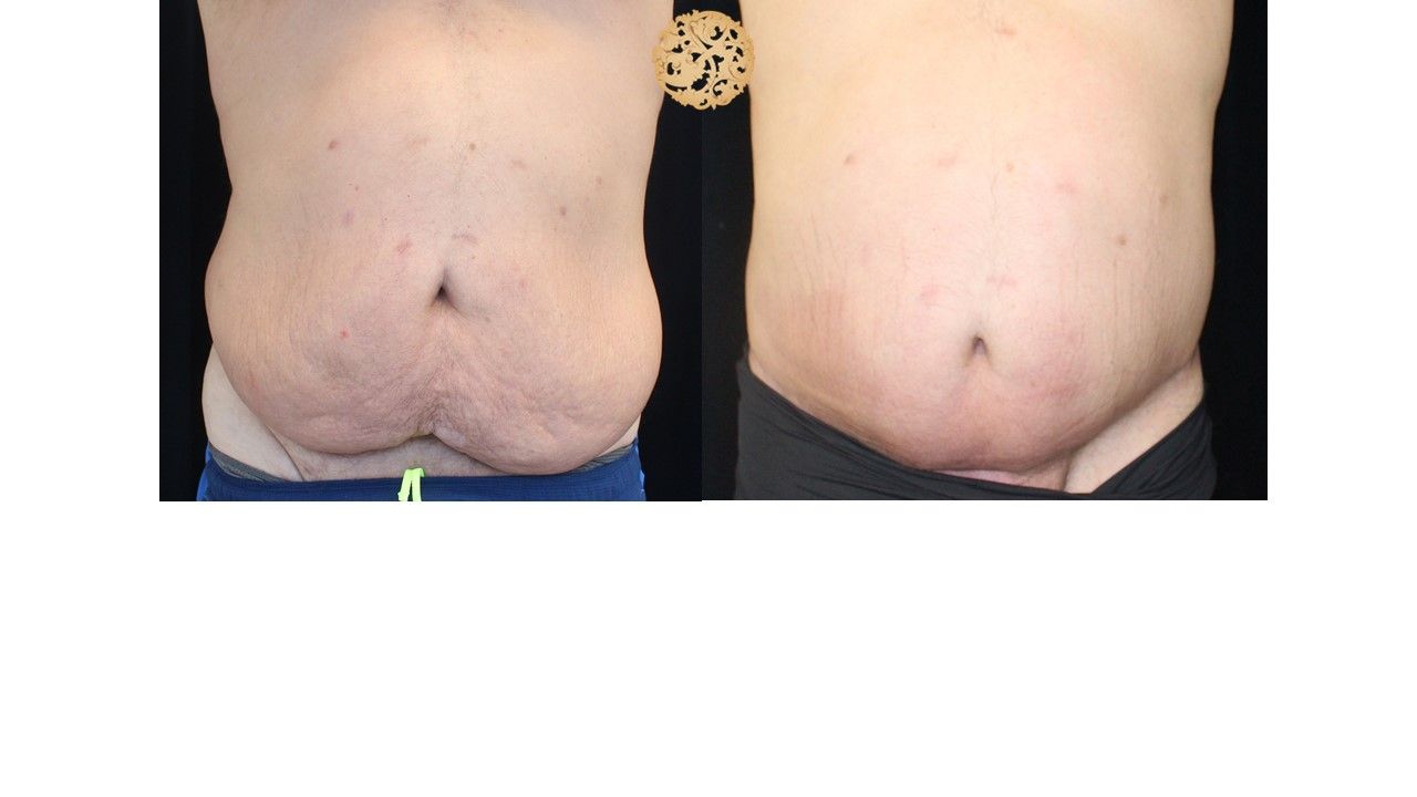 Panniculectomy Before & After