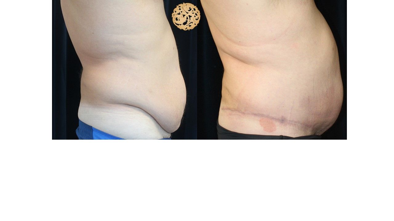 Panniculectomy Before & After