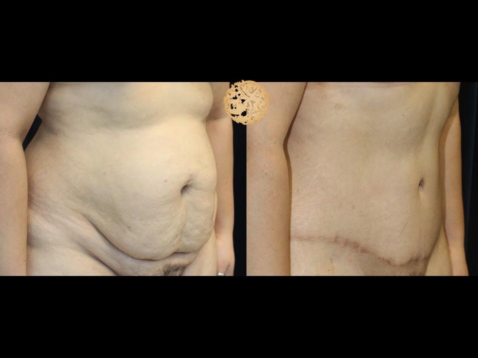 Panniculectomy Before & After