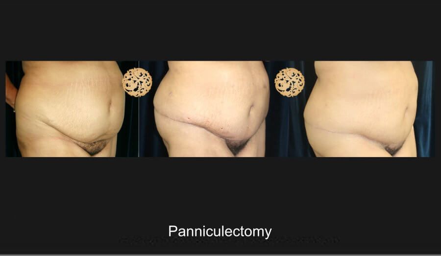 Panniculectomy Before & After