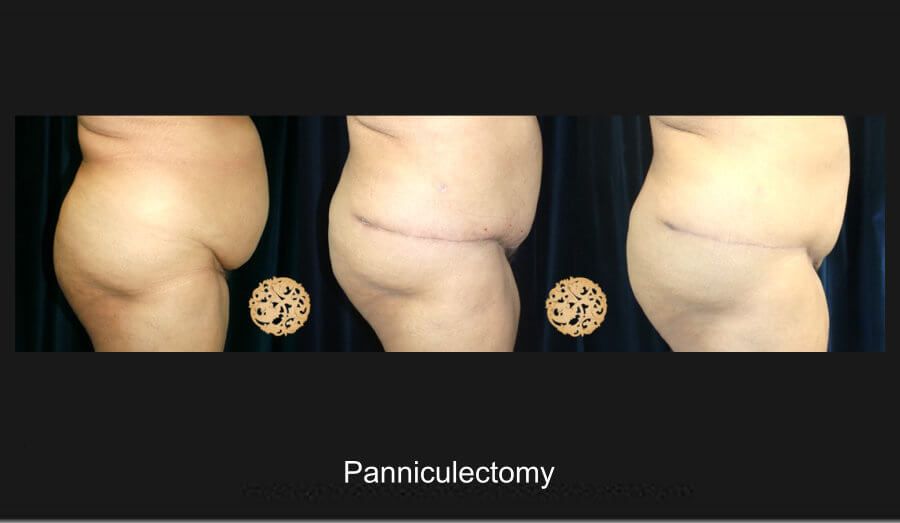 Panniculectomy Before & After